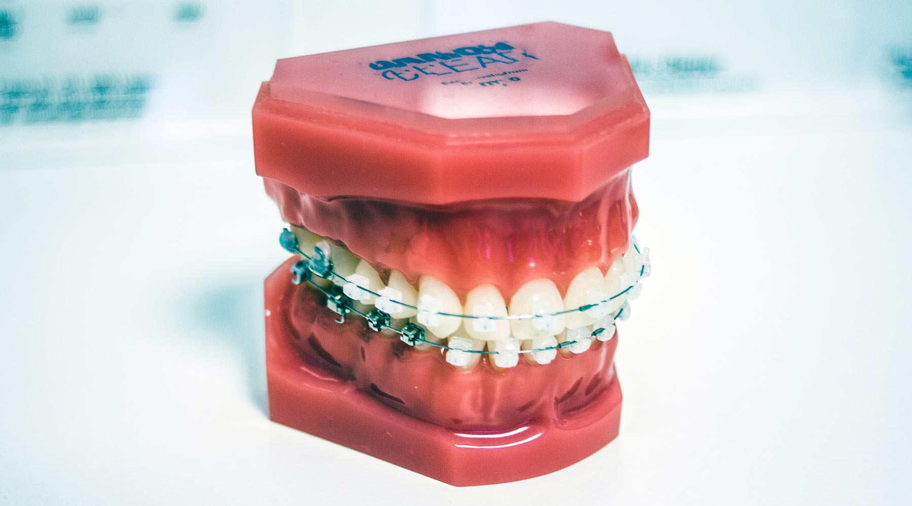 How long does orthodontic treatment with Damon braces take?