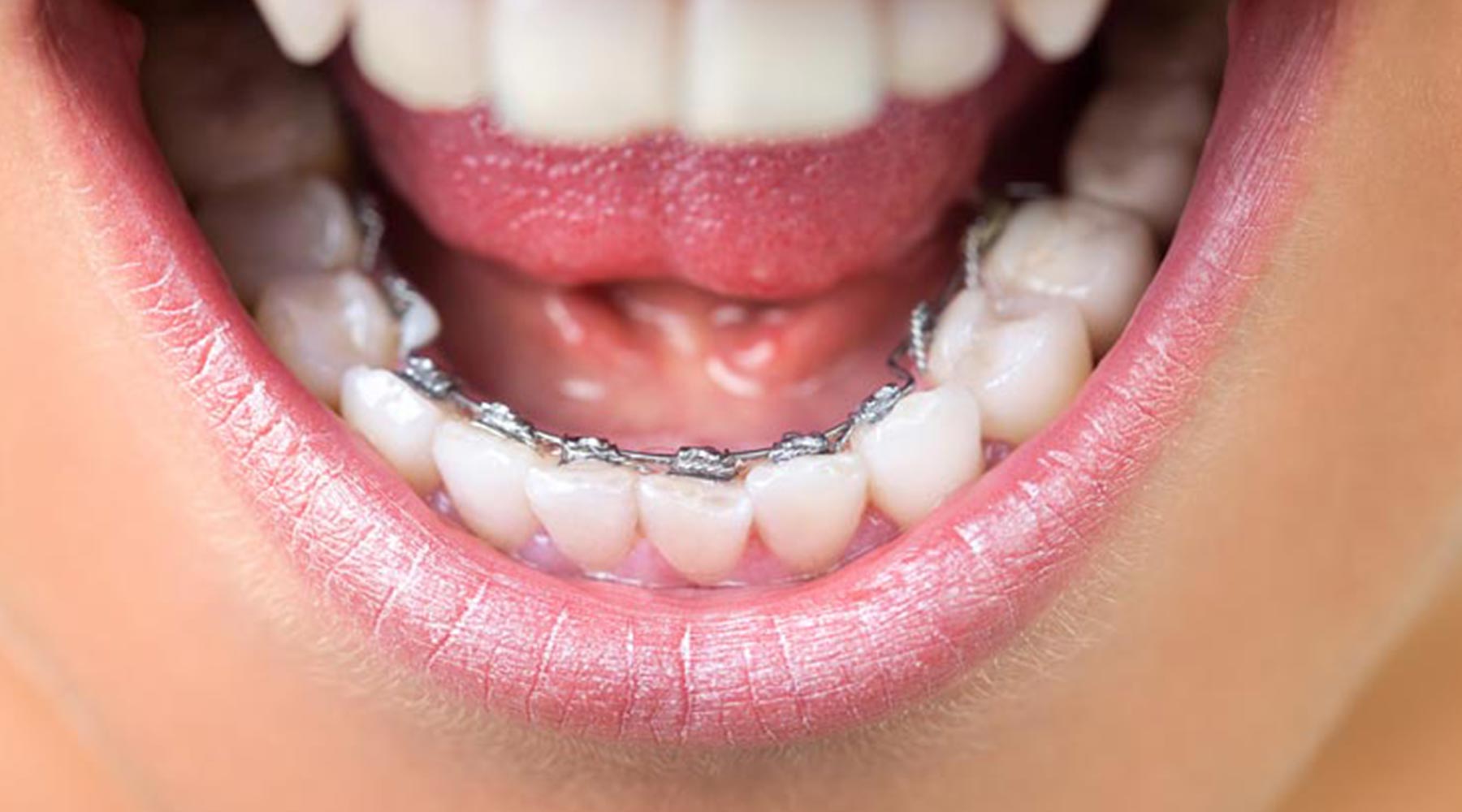 Lingual braces – before and after