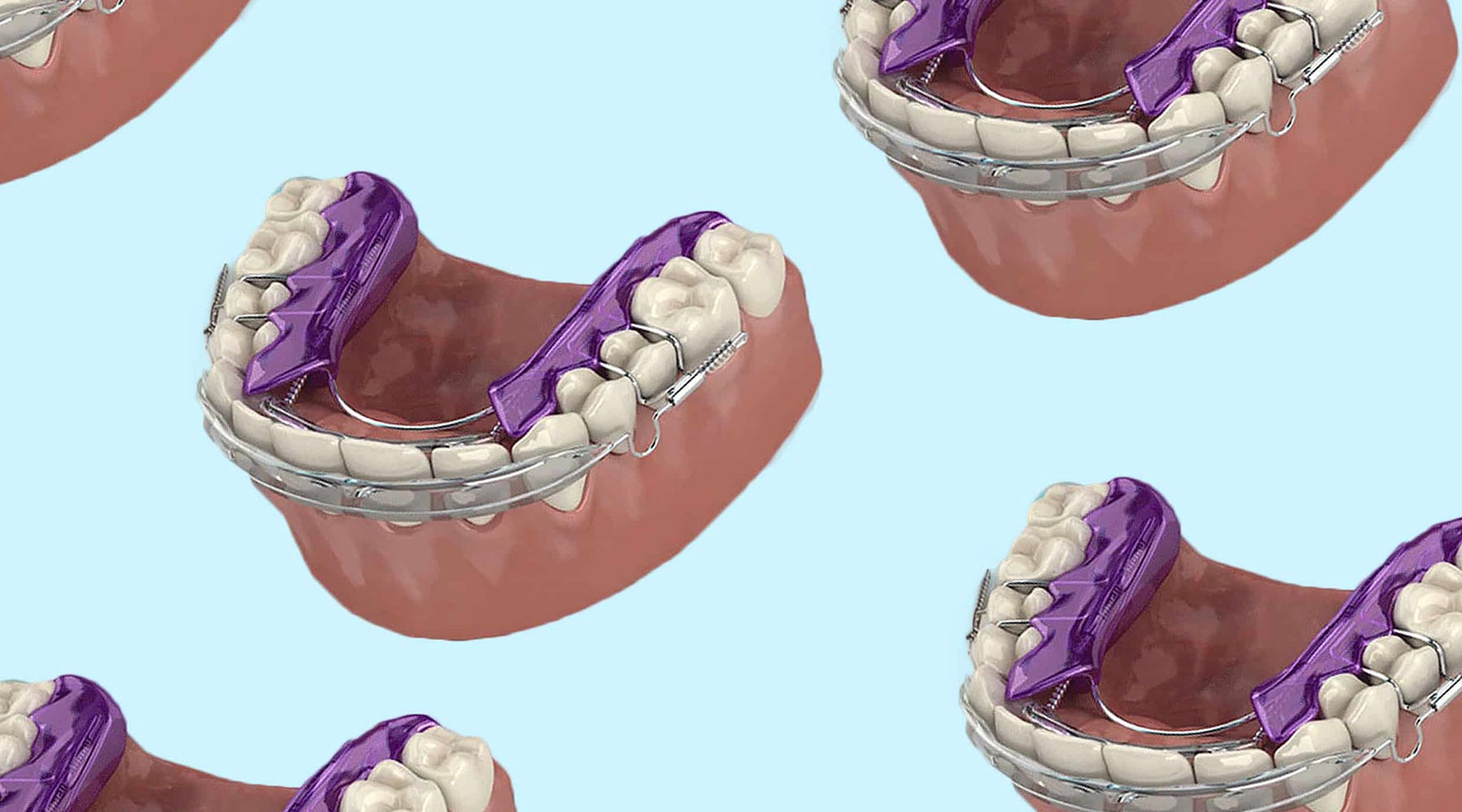 How much do Inman Aligners cost?