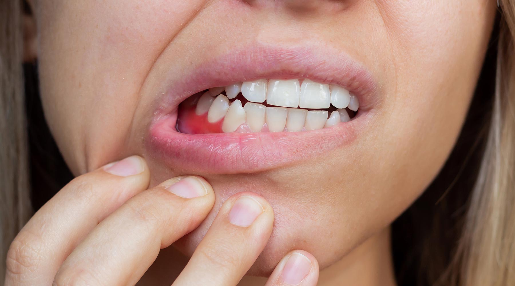 Top myths surrounding gum disease