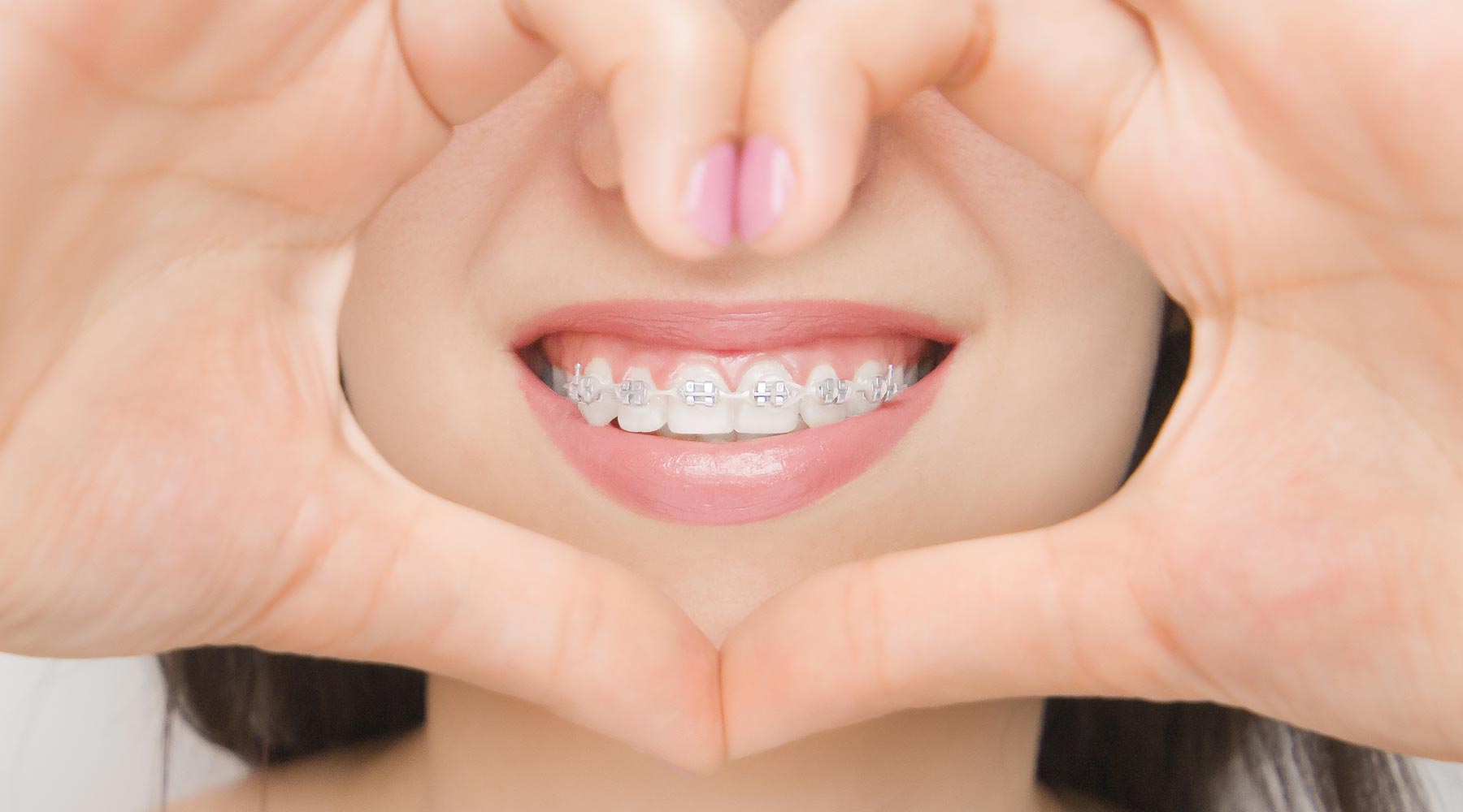 How to avoid the problems of ice clear orthodontic brackets