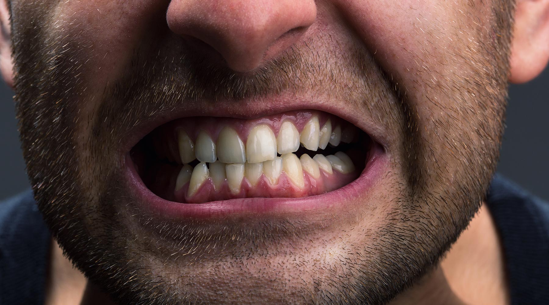 Protect your teeth from grinding (bruxism)